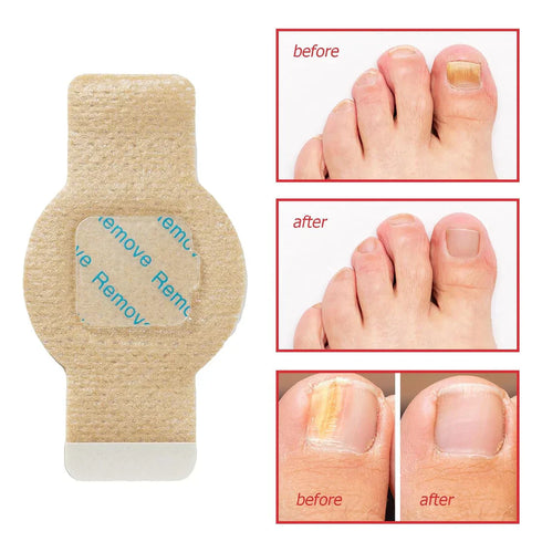 NailHeal™ – Fungal Nail Repair Patches 🌿💅 (Buy 1 Get 1 Free 🔥🔥)